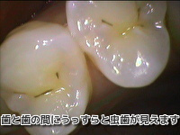 ジルコニアセラミック