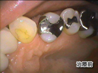 ジルコニアインレー