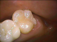 ジルコニアインレー