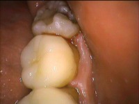治療前の状態